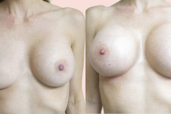 patient before and after her breast revision surgery in Nashville