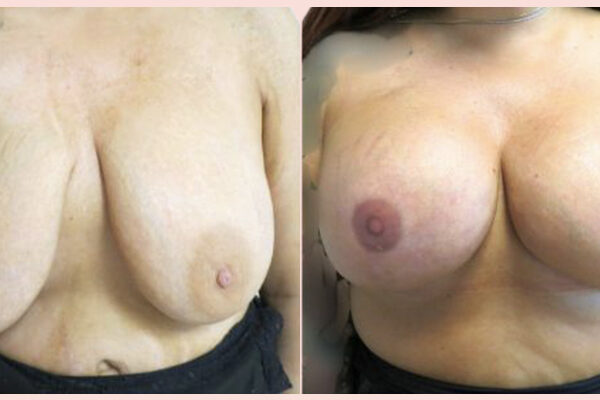 patient in Nashville before and after her fat grafting breast reconstruction