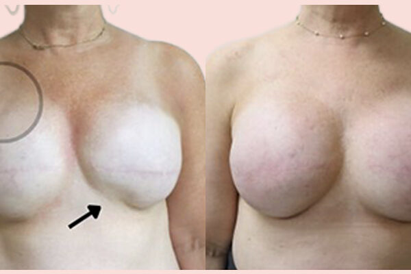 patient before and after her autologous reconstruction procedure in Nashville