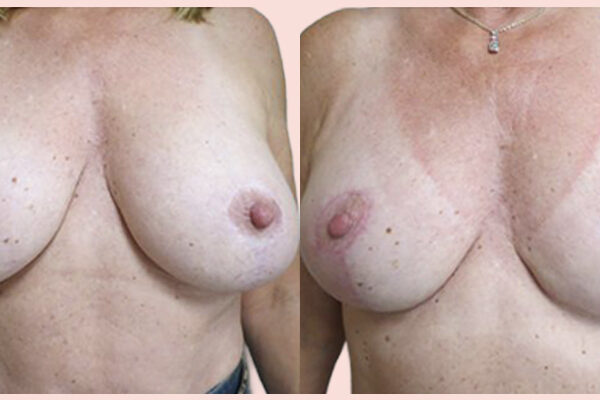 patient before and after her breast explant surgery in Nashville